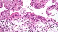 Micrograph of a mucinous ovarian tumor (Photo National Institutes of Health)