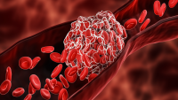Model of a blood clot